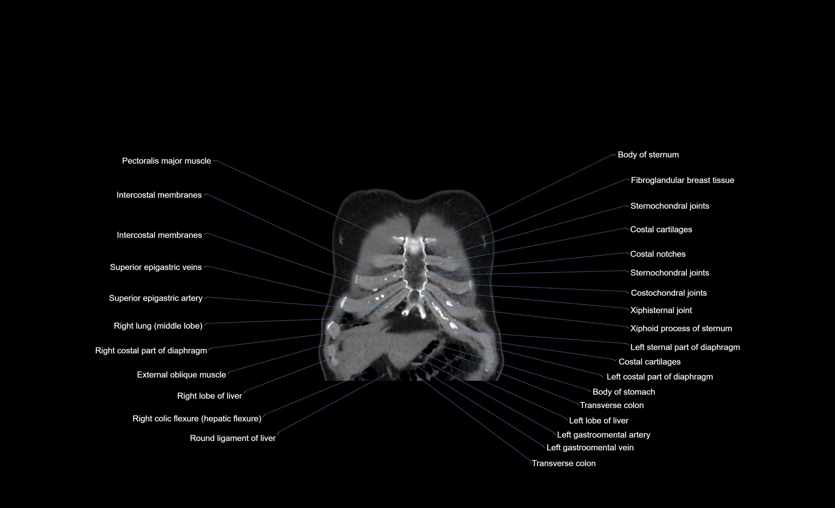 CT chest (thorax) labelled coronal cross sectional anatomy radiology image-00101.webp
